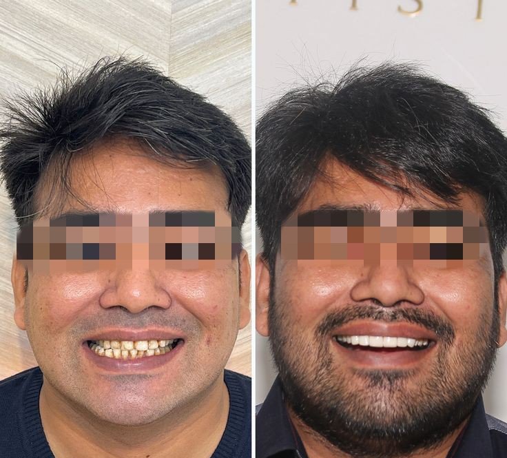 Before and after dental treatment result - IMG_20240125_173253.jpg