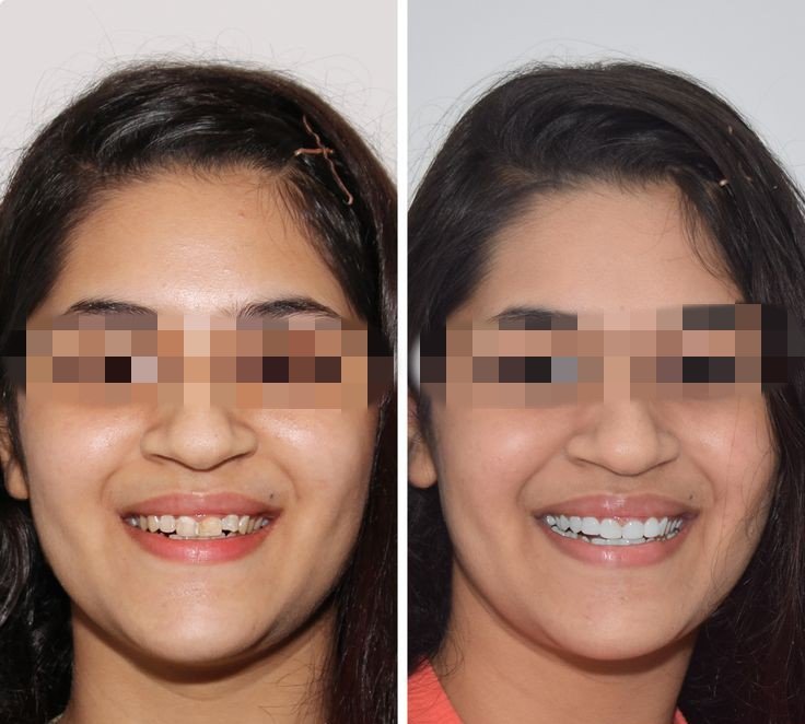 Before and after dental treatment result - IMG_20240125_173321.jpg