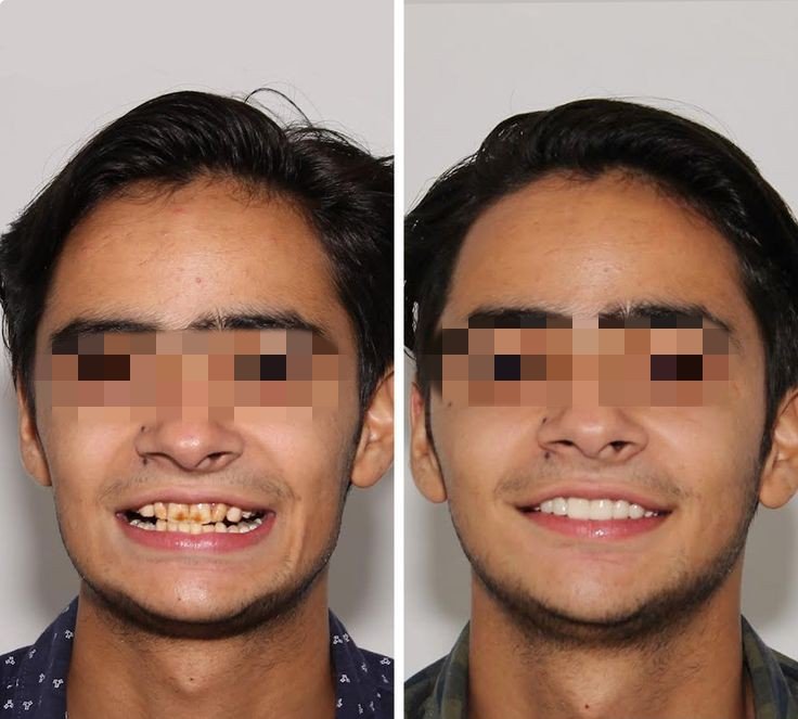 Before and after dental treatment result - IMG_20240125_173618.jpg