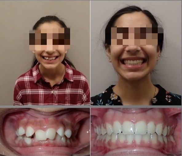 Before and after dental treatment result - IMG_20240125_174057.jpg