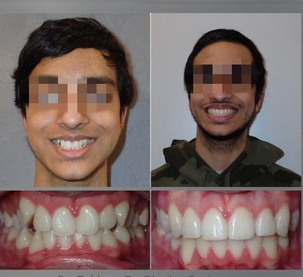 Before and after dental treatment result - IMG_20240125_174232.jpg