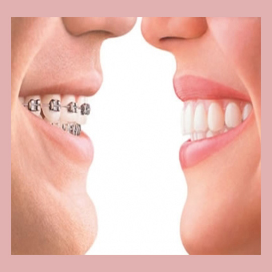 Teeth Alignment