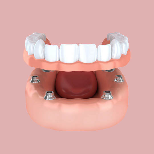 Fixed and removable dentures