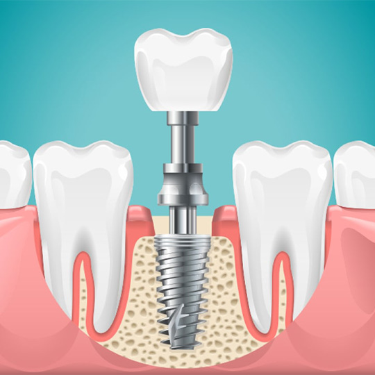 Dental Implants