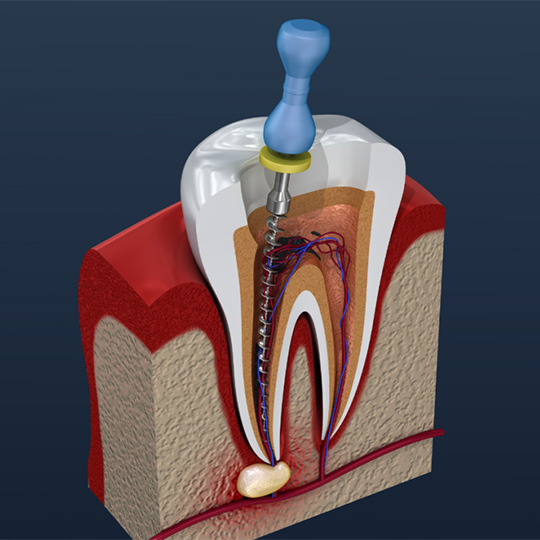 Root canal treatment